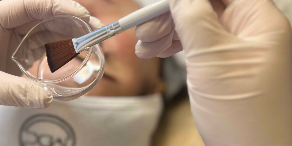 Medische peeling Medische peelings