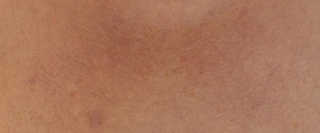 Couperose oorzaak Couperose oorzaak