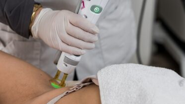 Is laserontharing permanent? Alles wat je moet weten