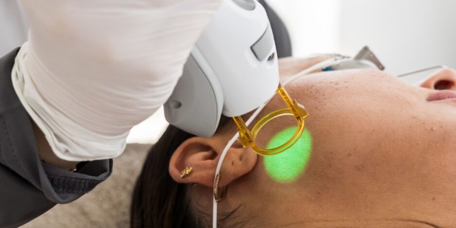 Laserontharing van het gelaat bij Medi Derma Clinic in Apeldoorn